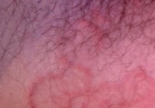 What Does Ringworm Eczema Look Like?