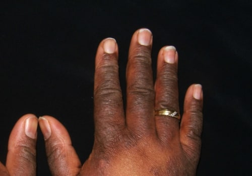 What is Eczema and How Can It Be Treated?