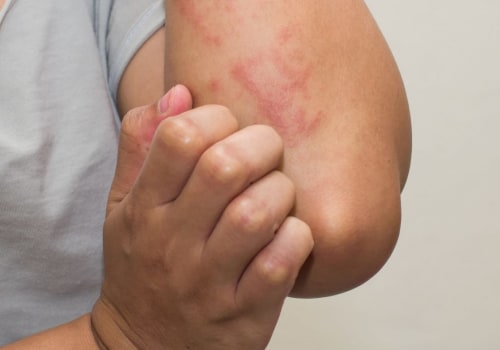 Do Dermatologists Treat Eczema? Expert Advice on Diagnosis, Treatment, and Follow-Up Care