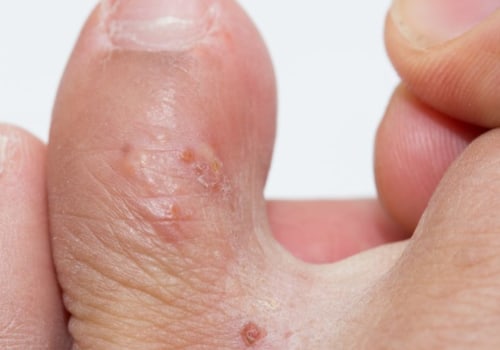 How to Quickly Get Rid of Eczema