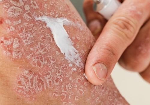 The Relationship between Eczema and Psoriasis