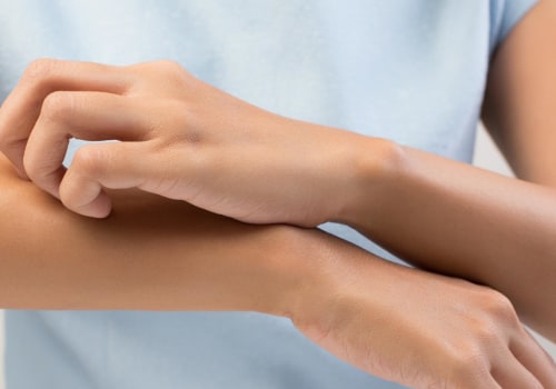 Eczema Creams: What's Safe During Pregnancy?
