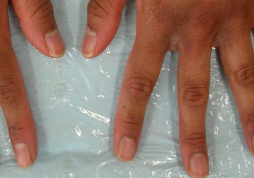 The Relationship between Vitiligo and Eczema